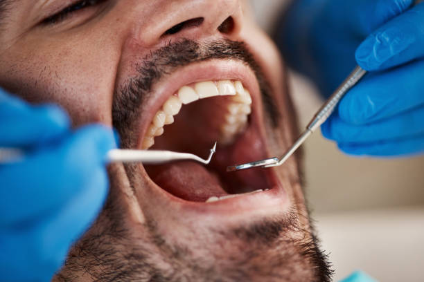 Best Emergency Wisdom Teeth Removal in Duncan, SC